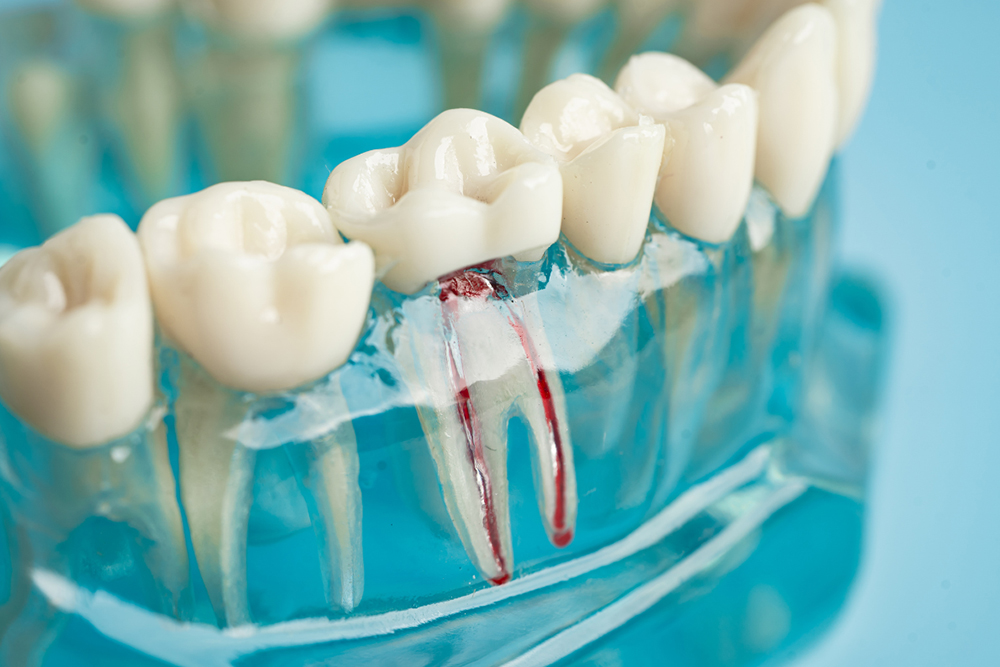 Root canals emergency treatment procedure at Foresto Dentistry Windsor Ontario