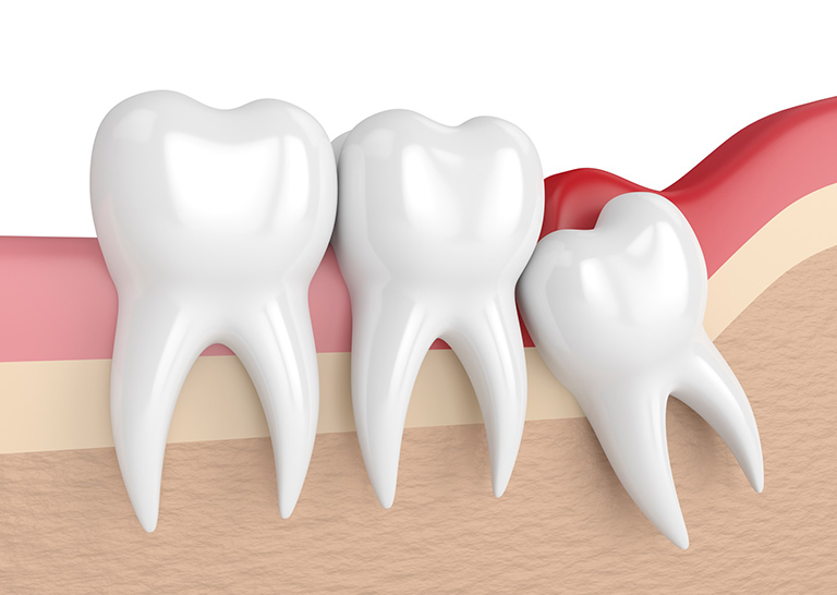 wisdom-teeth-removed